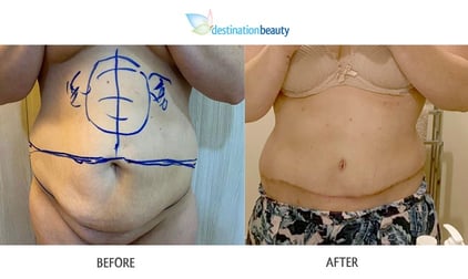 Lauren had Extended Tummy Tuck and Lipo surgery in Thailand!